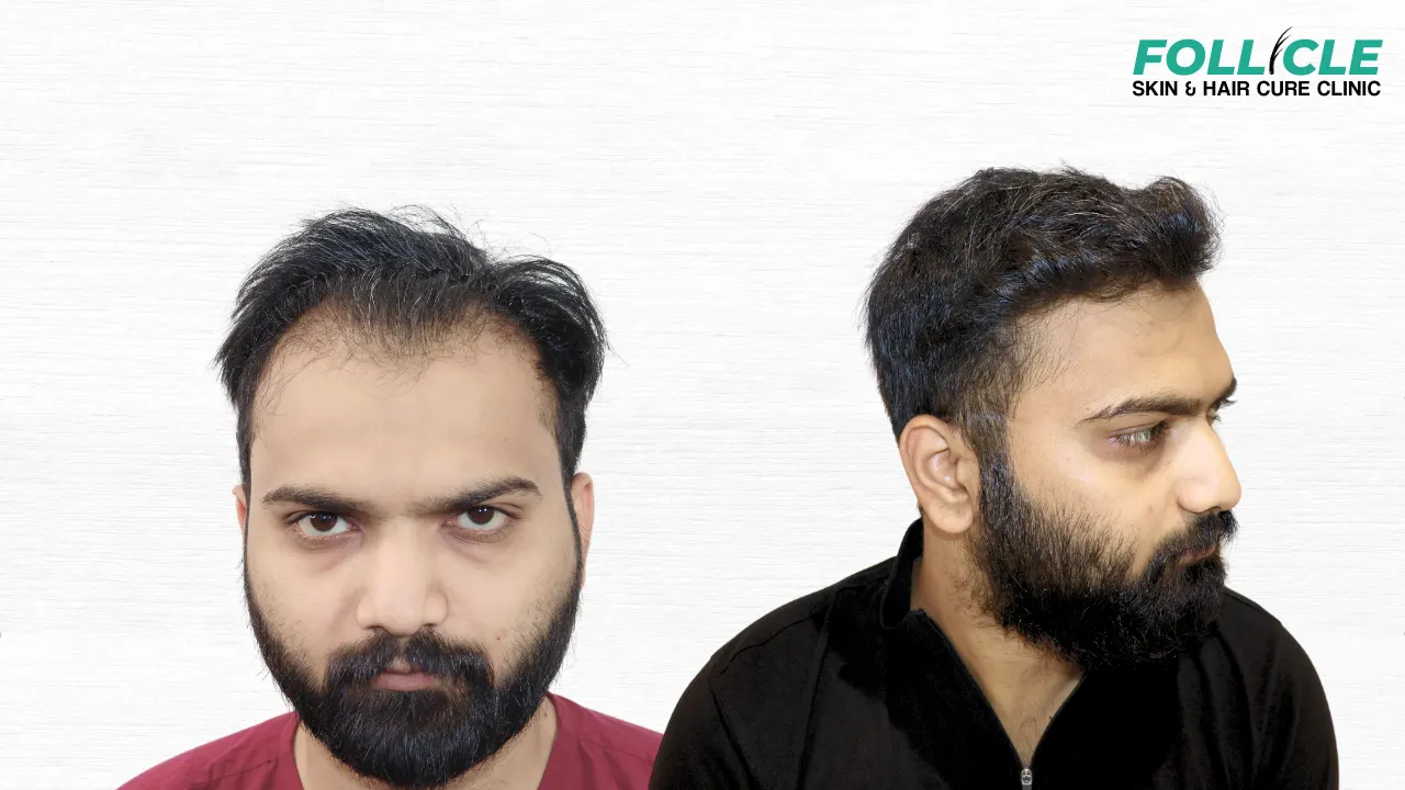 Aniket shinde (Hairline)