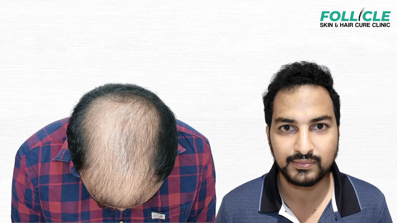 Fraison Francis (Hairline)