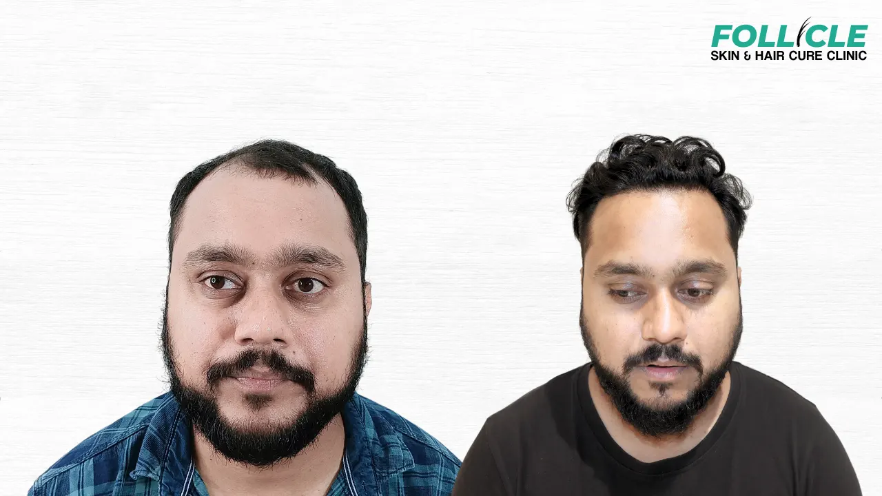 Namit Kumar (Hairline)