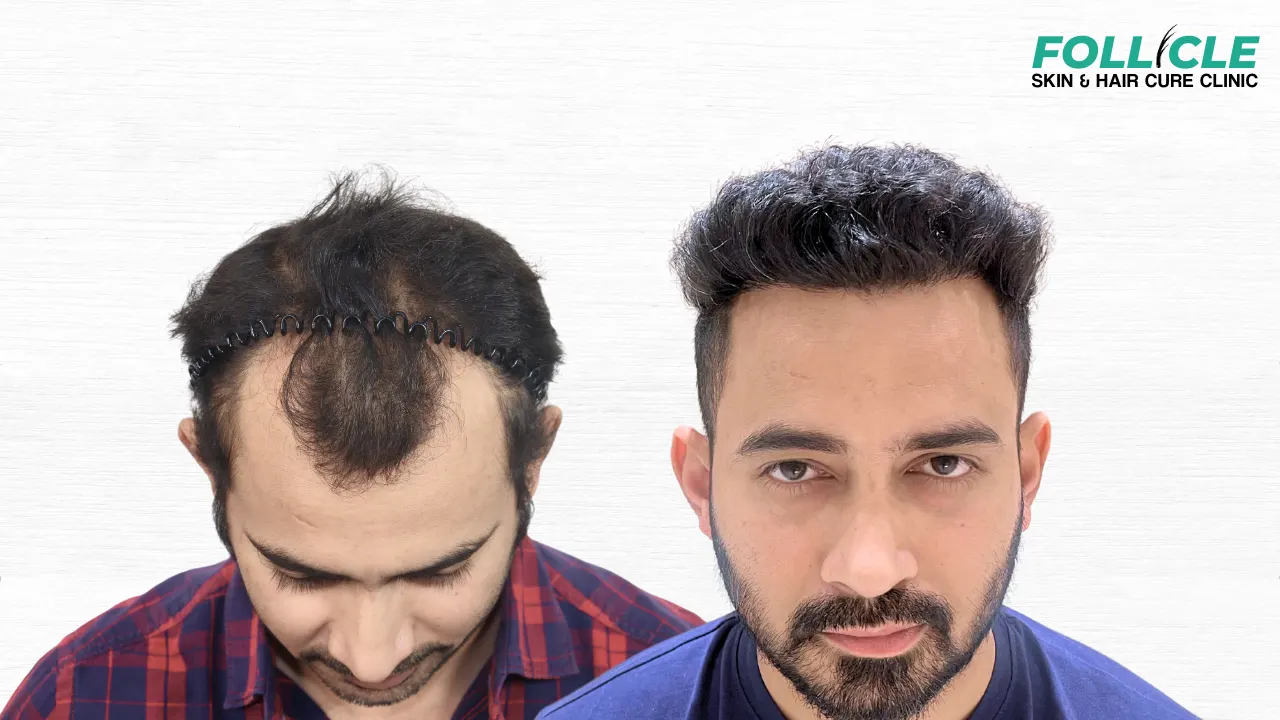 Sachin waykar (Hairline)