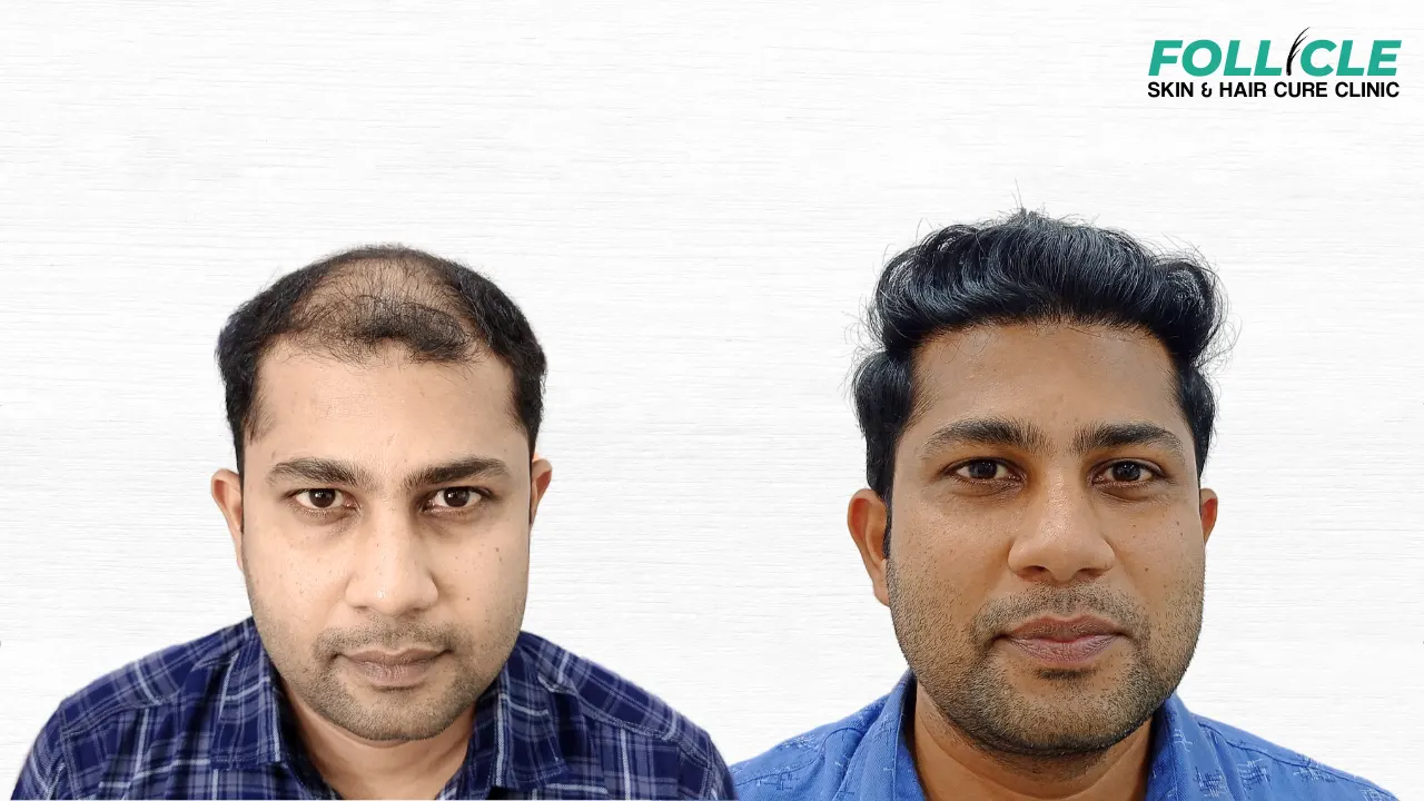 Shaneer Hanif (Hairline)